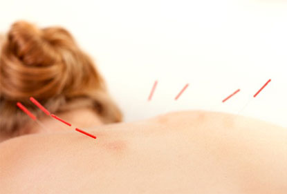 Acupuncture Photo